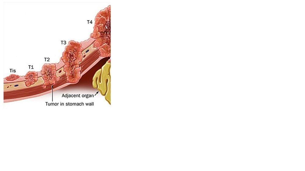 Sơ đồ các mức độ xâm lấn của một khối u ác tính ở dạ dày