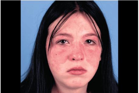 Hình ảnh bệnh lupus ban đỏ: Phát ban hình cánh bướm
