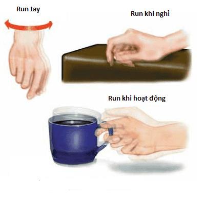 Biểu hiện của run tay