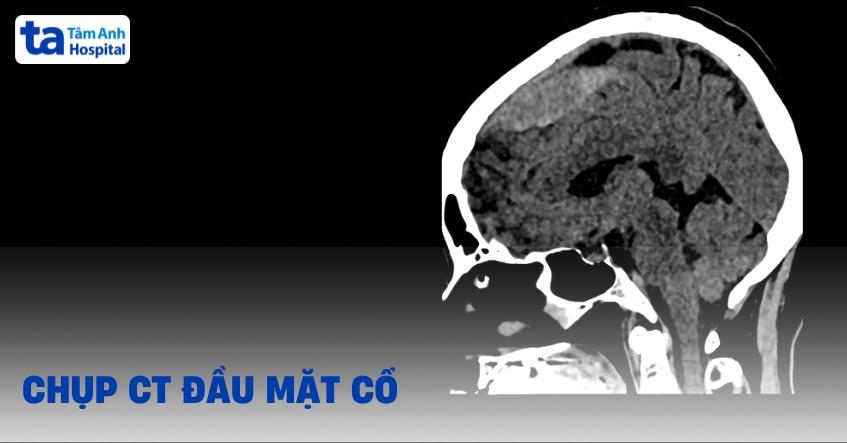 chụp CT đầu mặt cổ