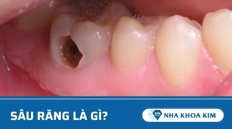 Sâu răng là gì?