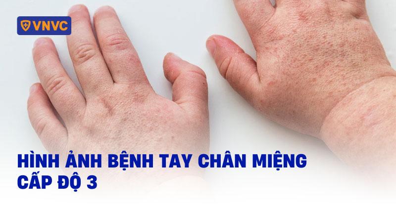 hình ảnh bệnh tay chân miệng cấp độ 3