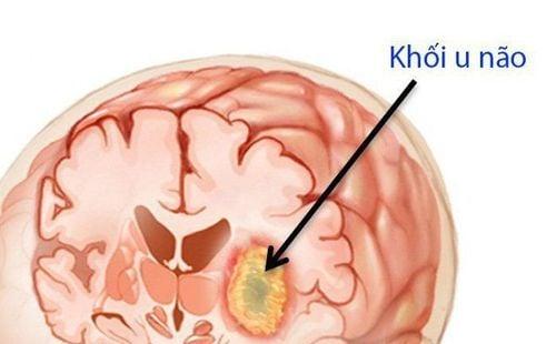 Bệnh nhân có khối u não được chỉ định chụp cắt lớp vi tính