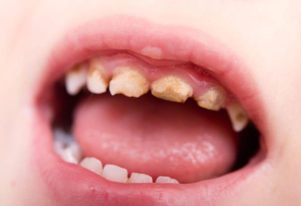 14 tuổi có bọc răng sứ được không? Có ảnh hưởng gì không? 1