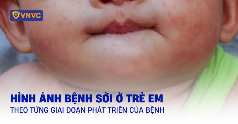 hình ảnh bệnh sởi ở trẻ em
