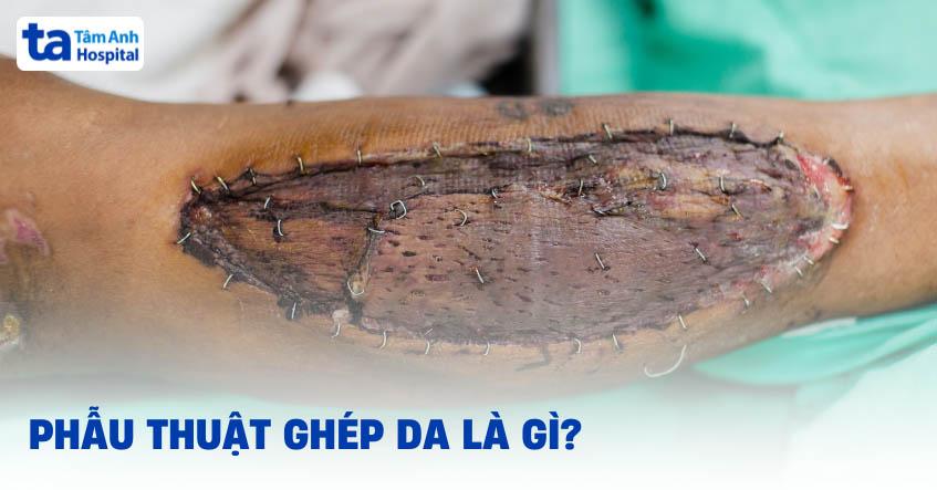 Kỹ thuật phẫu thuật ghép da là gì