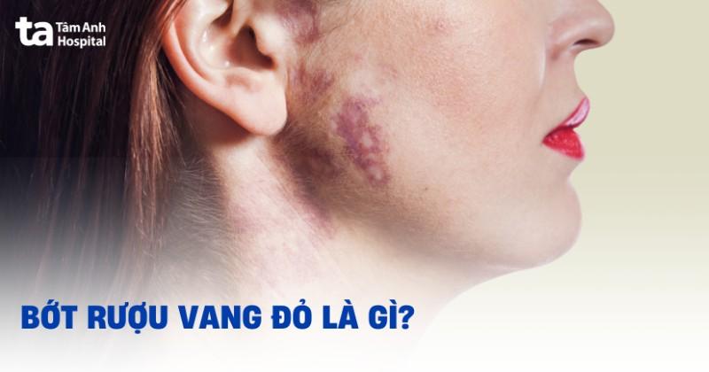 bớt rượu vang
