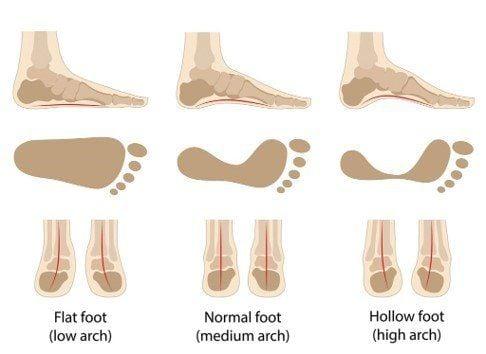 Bàn chân bẹt/bàn chân bình thường/bàn chân vòm cao (từ trái qua phải)