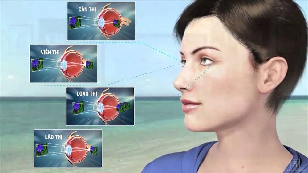 Mắt bị tật khúc xạ sẽ khiến người bệnh gặp khó khăn về thị lực
