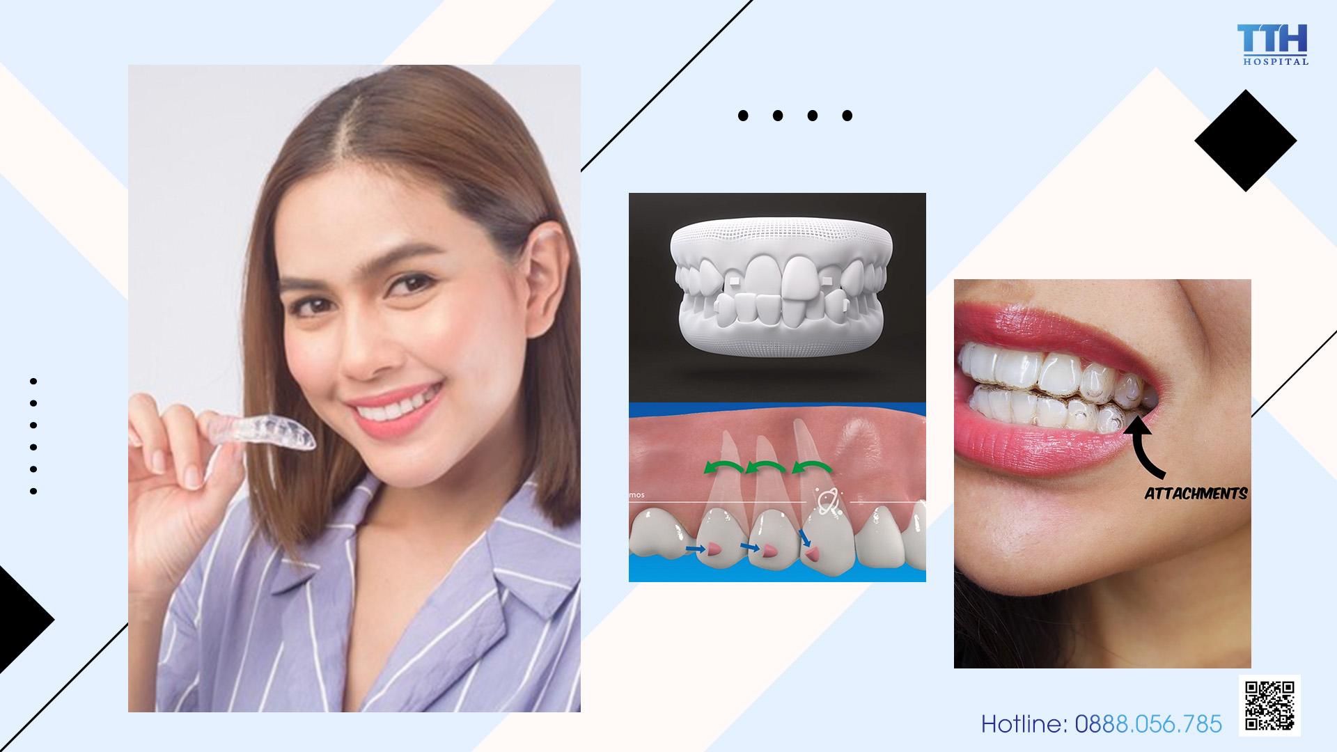 Miếng đệm răng SmartForce giúp quá trình niềng răng tong suốt Invisalign trở nên hiệu quả hơn, đặc biệt là với những trường hợp phức tạp