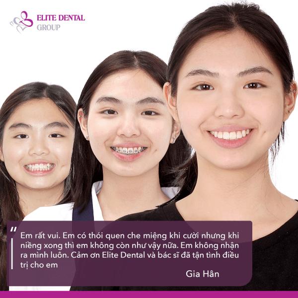 nên niềng răng mắc cài hay trong suốt