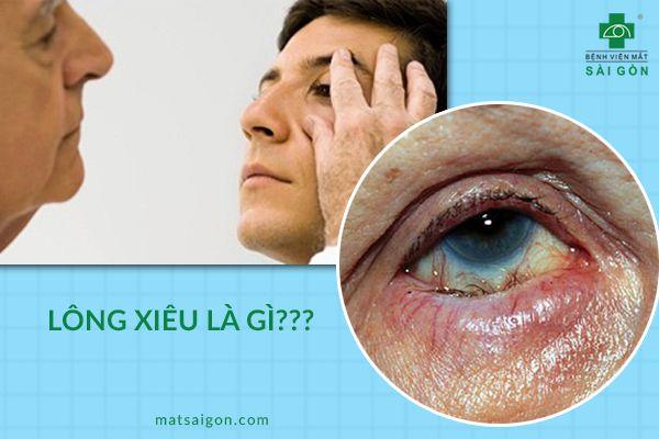 nguyên nhân lông xiêu