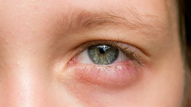 Vùng da quanh mắt bị sưng đỏ do đâu và cách khắc phục